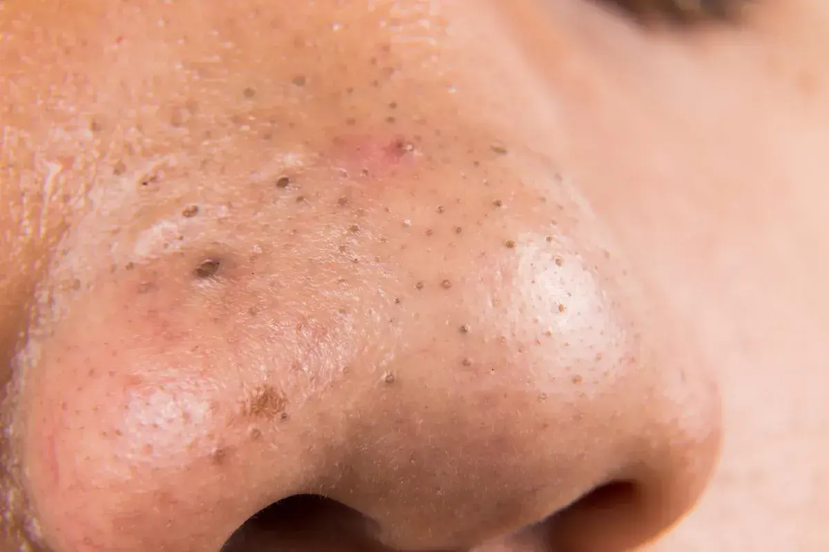 Primo piano del naso con pori dilatati e punti neri. Si vede cosa esce dai punti neri, accumuli di sebo e cellule morte.