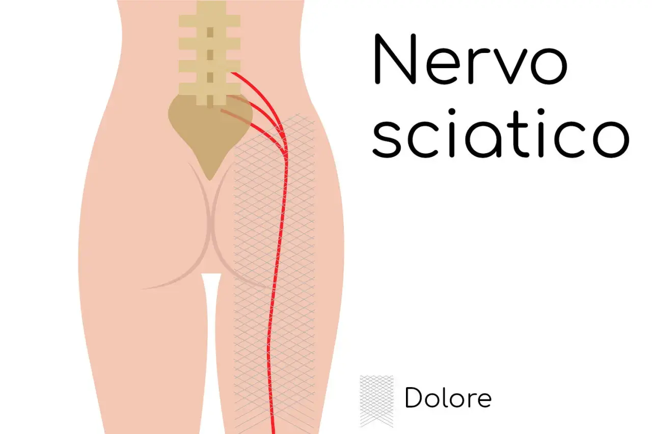 Illustrazione del nervo sciatico e del dolore al polpaccio. Rimedi per la sciatica.