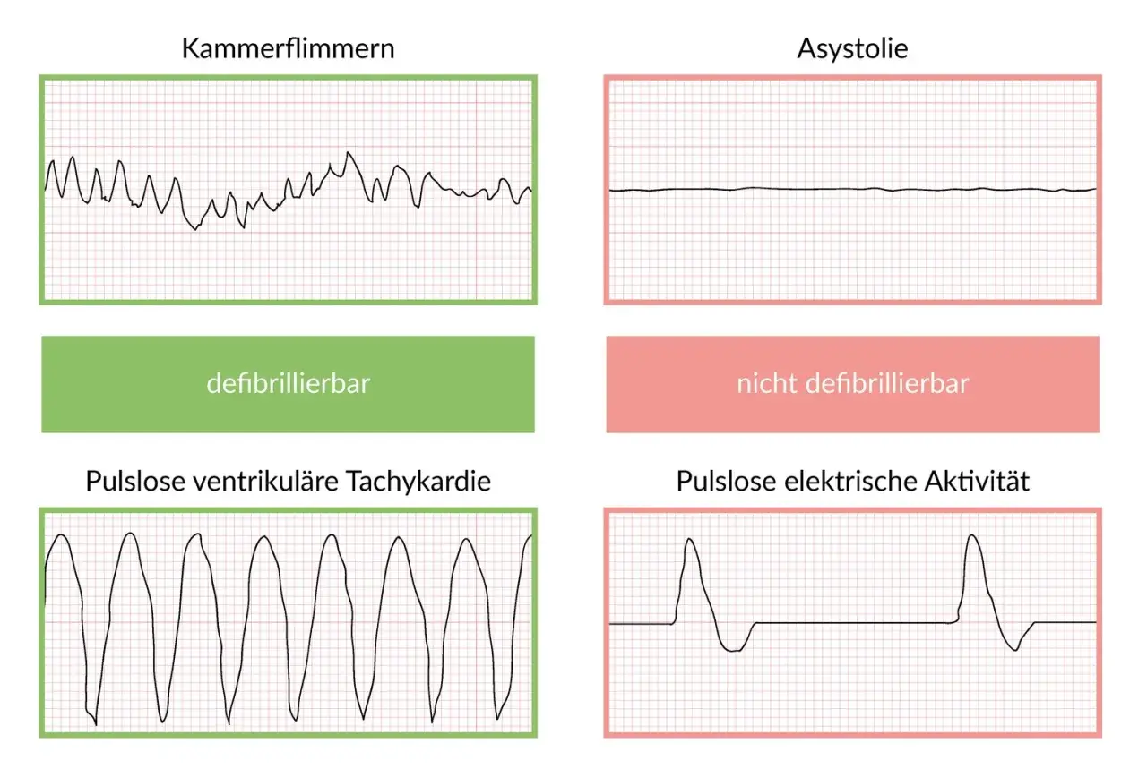 EKG-Kurven: Kammerflimmern & pulslose ventrikuläre Tachykardie (defibrillierbar) vs. Asystolie & pulslose elektrische Aktivität (nicht defibrillierbar). Wichtig für Lebenserwartung nach Reanimation.