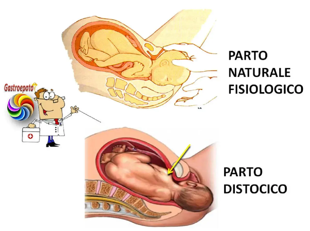 Illustrazione di un parto naturale fisiologico e di un parto distocico, dove il bambino è in posizione anomala.