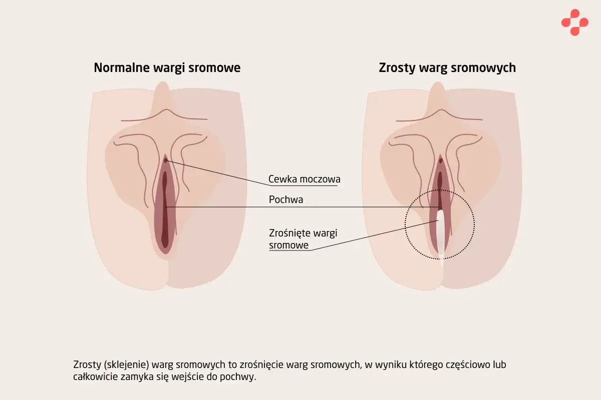 Ilustracja pokazuje, jak wygląda cipa: normalne wargi sromowe i zrośnięte wargi sromowe, z zaznaczoną cewką moczową i pochwą.