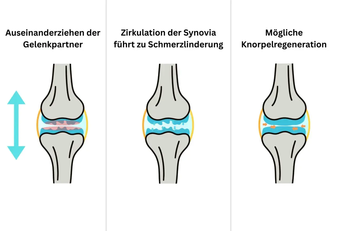 Illustration zeigt Knie-Distraktion: Gelenkpartner ziehen auseinander, Synovia-Zirkulation lindert Schmerz, Knorpel kann sich regenerieren.