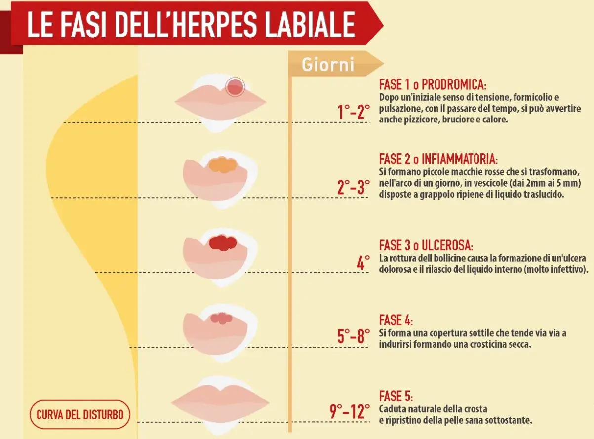 Le fasi dell'herpes labiale: dalla fase prodromica (1-2 giorni) con pizzicore, alla formazione di vescicole (2-3 giorni), ulcere (4° giorno), crosticine (5-8 giorni) fino alla guarigione (9-12 giorni). Le cause del herpes labiale frequente sono legate ...