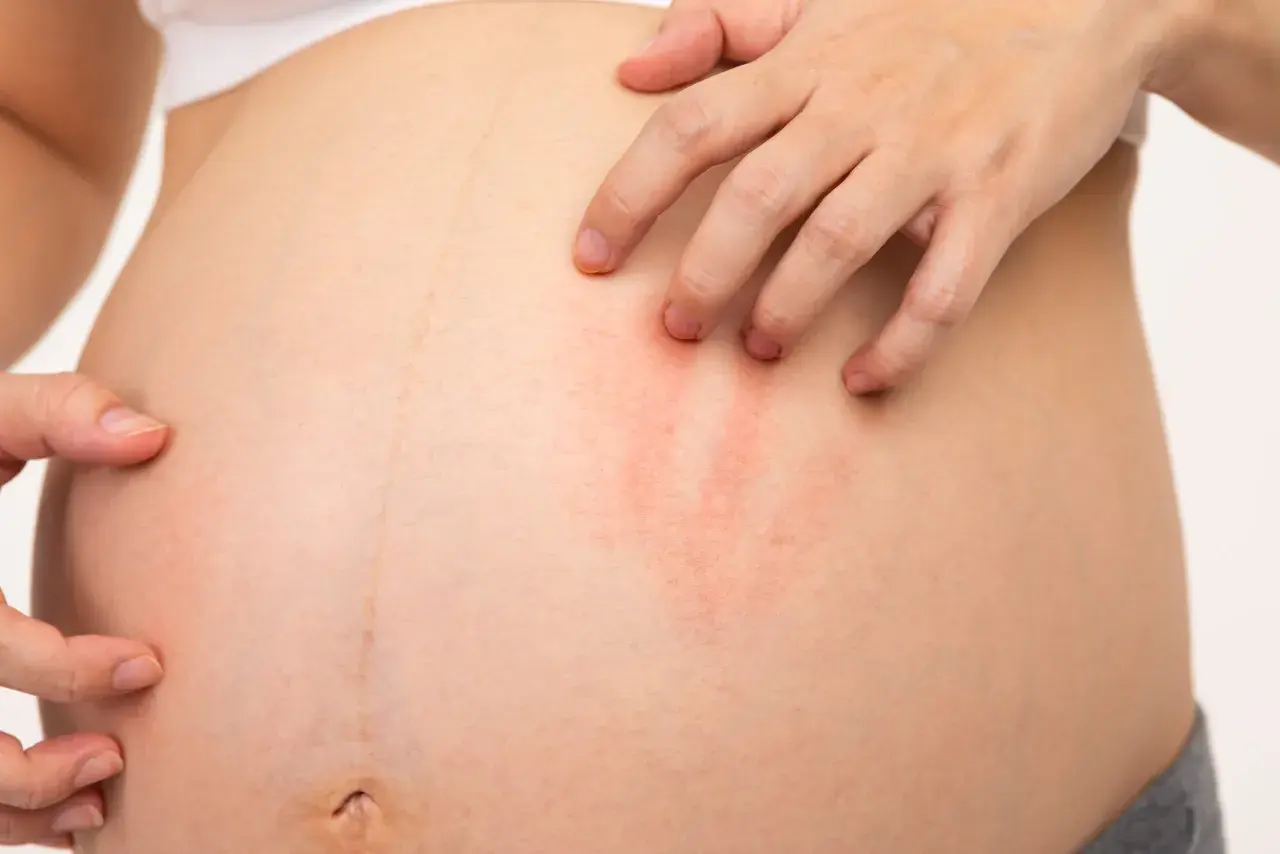 Une main gratte la peau d'une femme enceinte, révélant une rougeur.