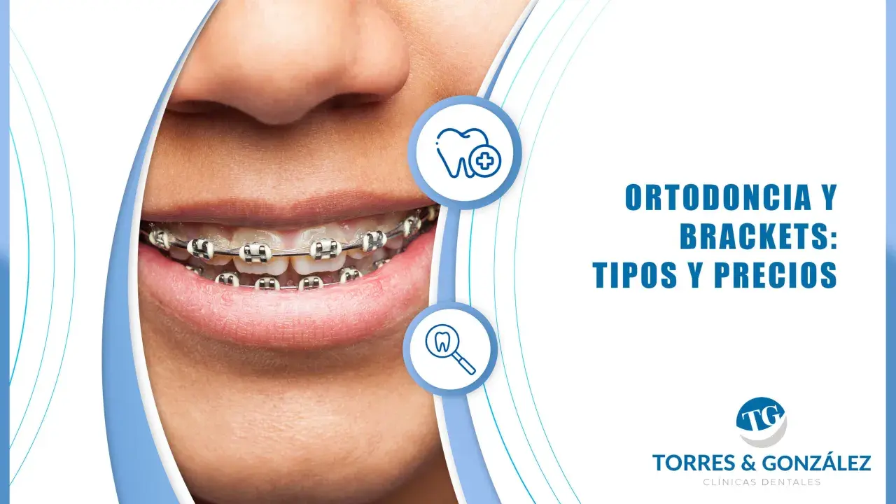 Sonrisa con ortodoncia. Descubre cuánto cuesta la ortodoncia y los tipos de brackets disponibles en Torres & González.