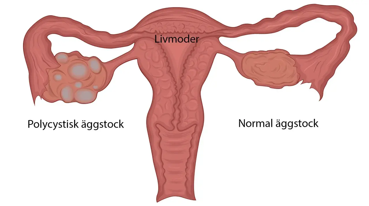 Illustration av livmoder med en normal äggstock och en polycystisk äggstock, en vanlig pcos symptom.