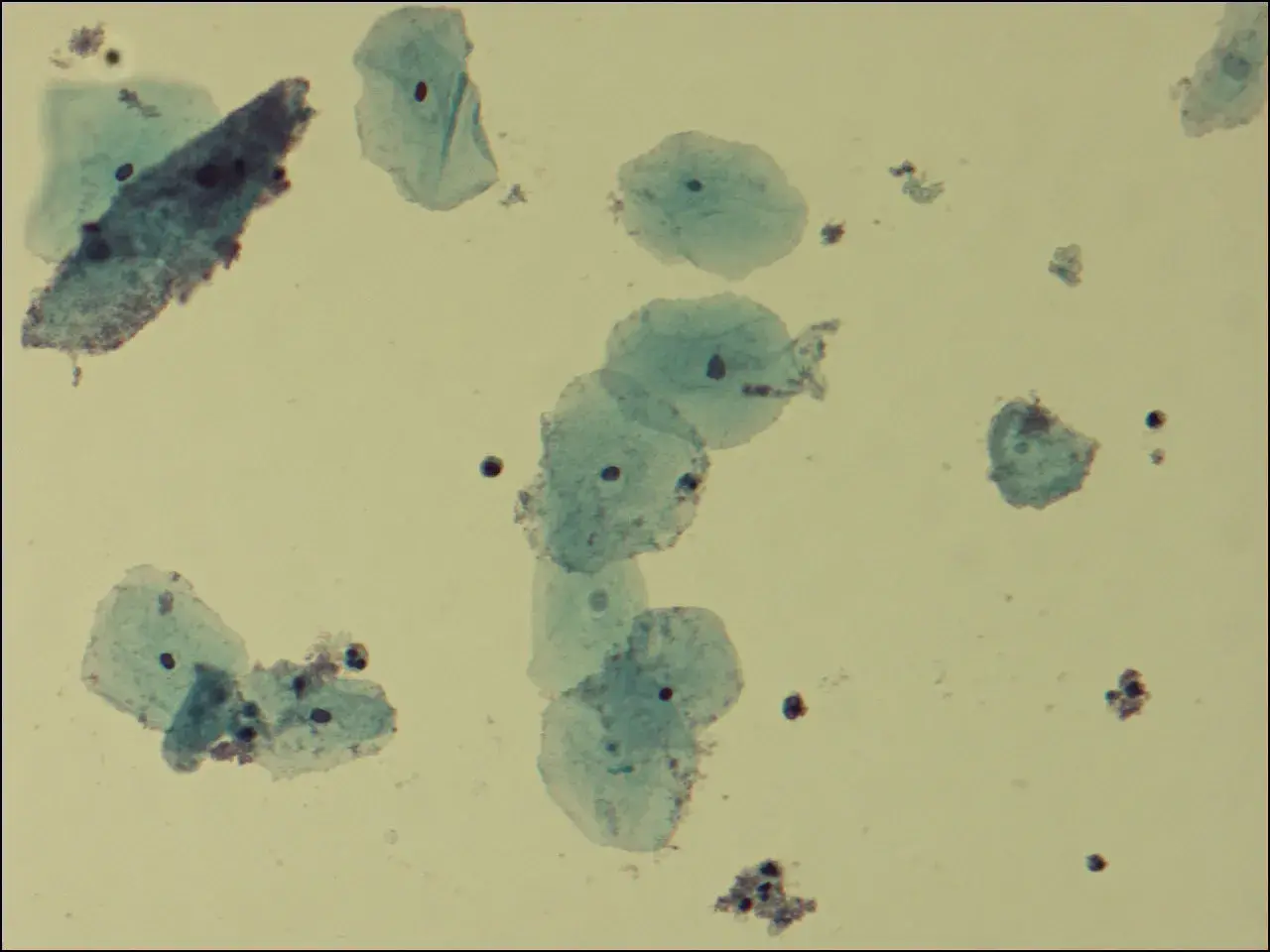 Cellules épithéliales et quelques bactéries, possiblement liées à la gardnerella transmission par l'homme.