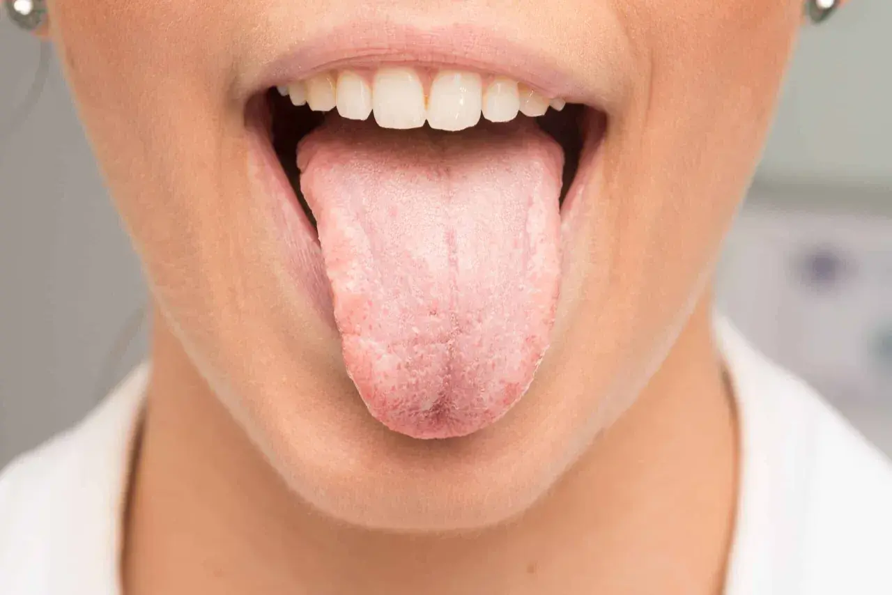 Boca abierta mostrando lengua rosada y blanca, con posible acidez en la boca y lengua.