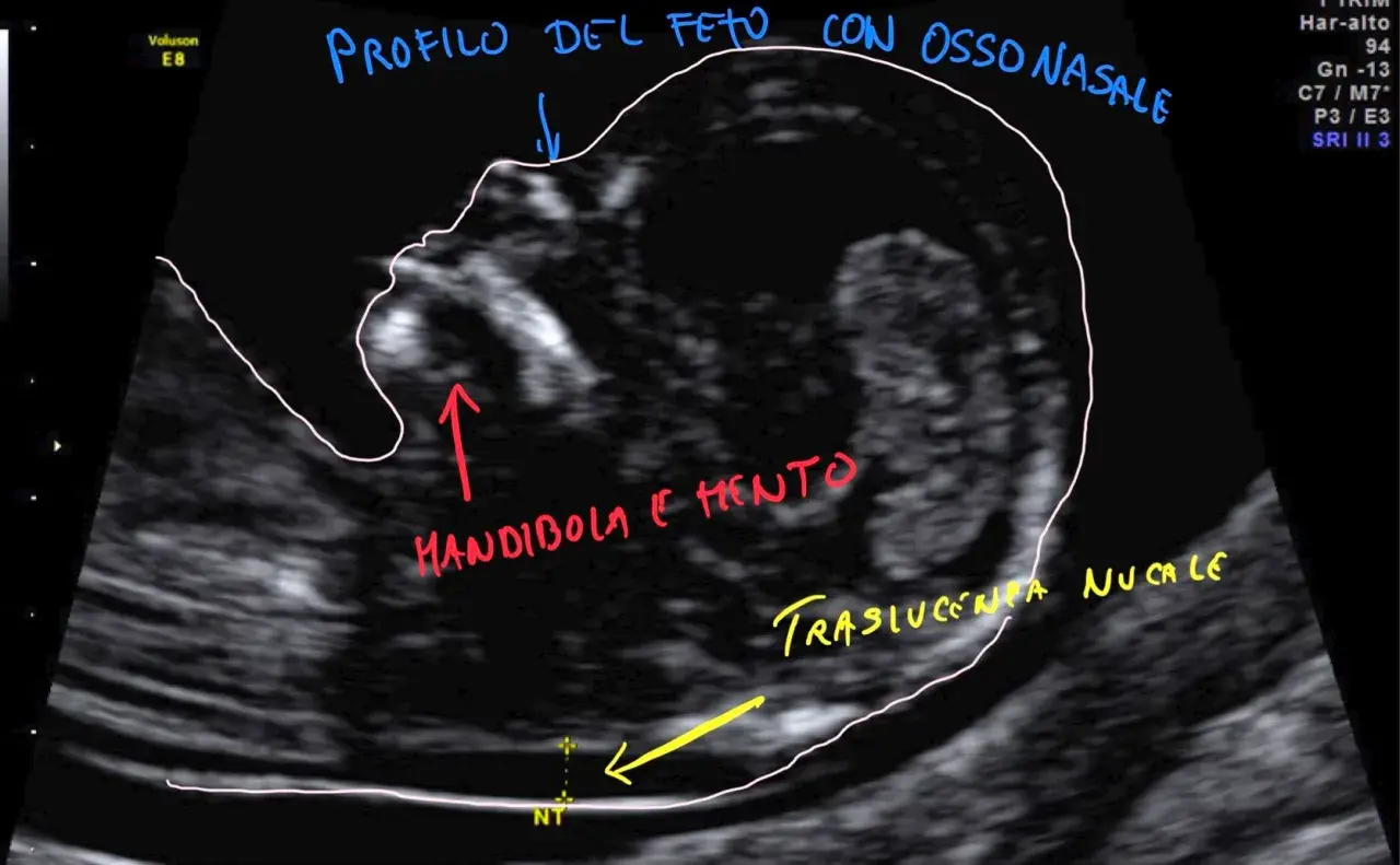 Profilo fetale con osso nasale, mandibola e mento visibili. Misurazione traslucenza nucale (NT) per bi test.