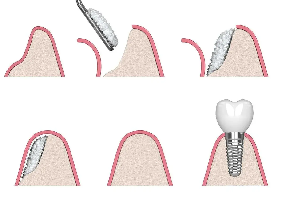 Illustrazione delle fasi di un innesto osseo dentale: preparazione, aggiunta di materiale osseo e inserimento dell'impianto.