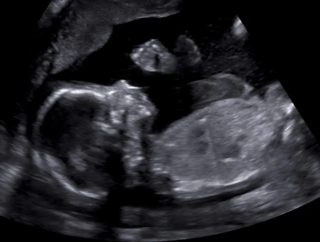 Ultraljudsbild visar två foster. Tidiga symptom på gravid med tvillingar kan vara mer uttalade.