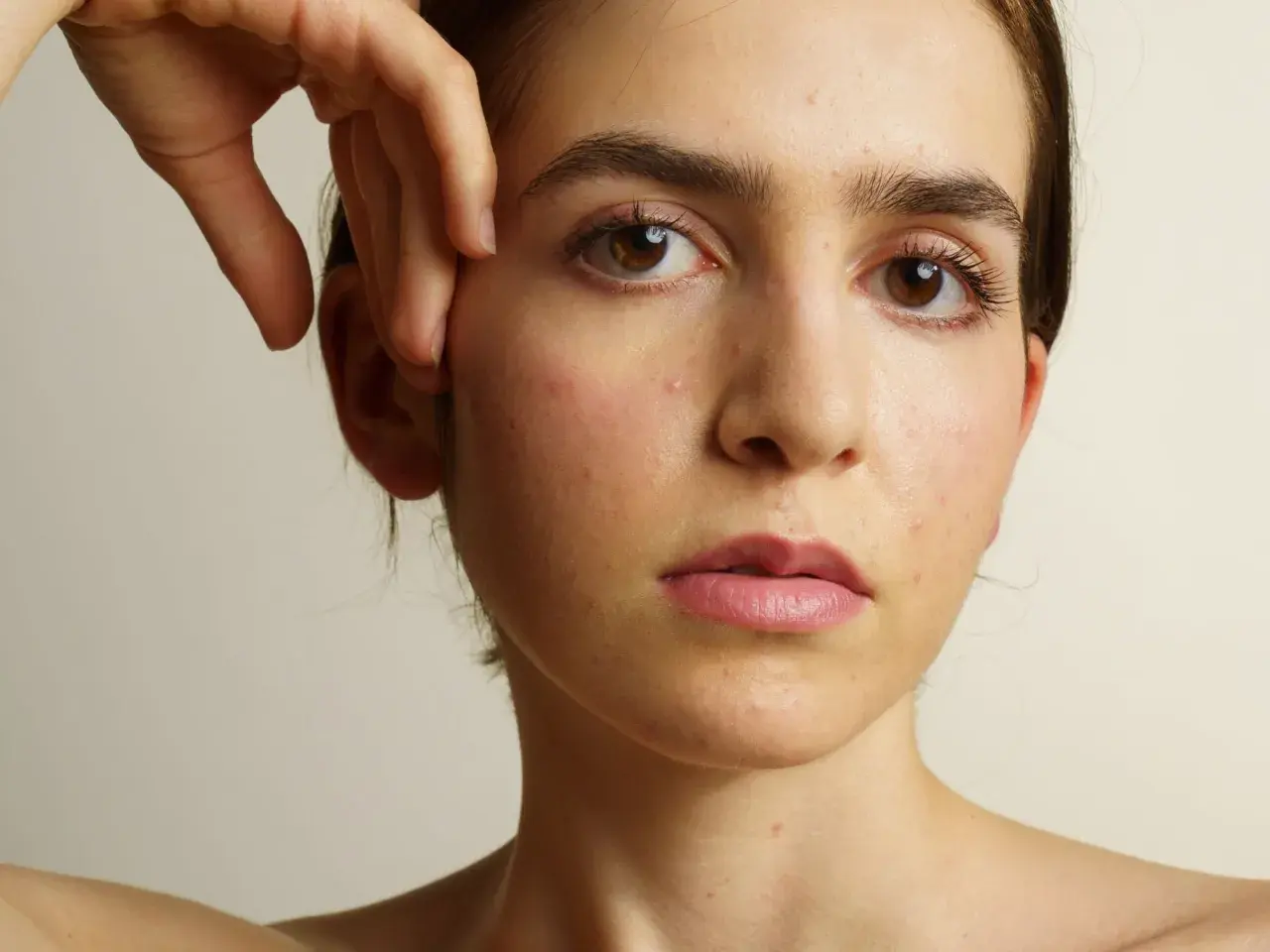 Visage d'une jeune femme aux yeux marron, présentant des rougeurs et des imperfections cutanées, évoquant l'acné et la ménopause.