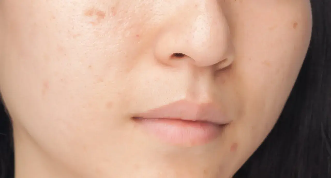 Närbild på en persons ansikte med synliga pigmentfläckar och ojämnheter i melanin hud.