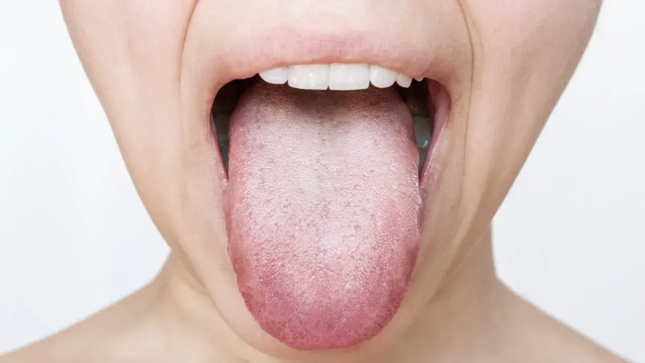 Lingua arrossata e con papille evidenti, possibile segno di candidosi orale.