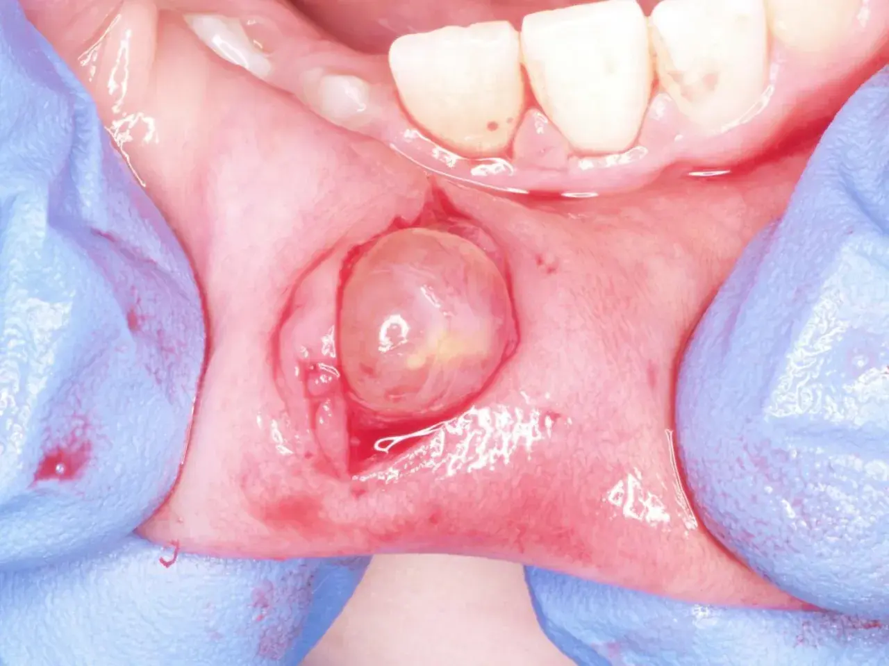 Gloved hands retracting tissue to reveal a translucent, rounded lesion on the gum, likely a fibroma orale.