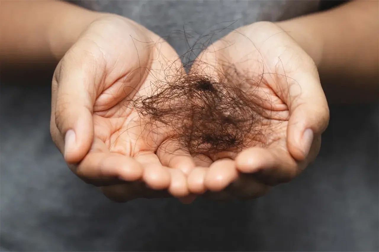 Manos sostienen un puñado de cabello suelto, un signo visible de efluvio telógeno crónico.