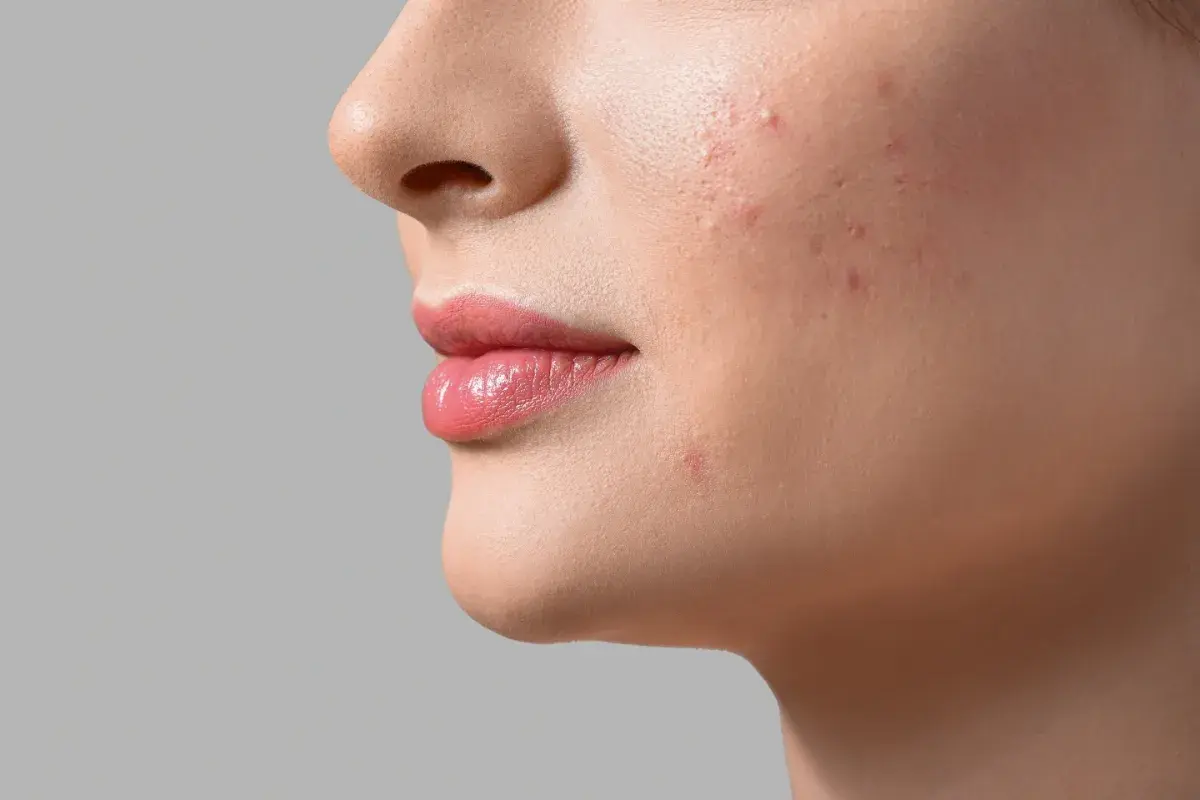 Primo piano del viso di una donna con imperfezioni. La pelle beneficia di niacinamide e acido glicolico per un aspetto più uniforme.