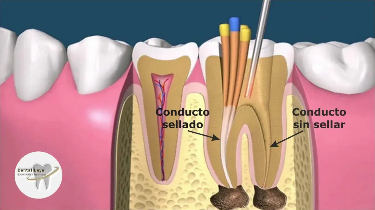 Ilustración de un diente mostrando un conducto radicular sellado y otro sin sellar, con instrumentos dentales. Esto explica qué es una reendodoncia.