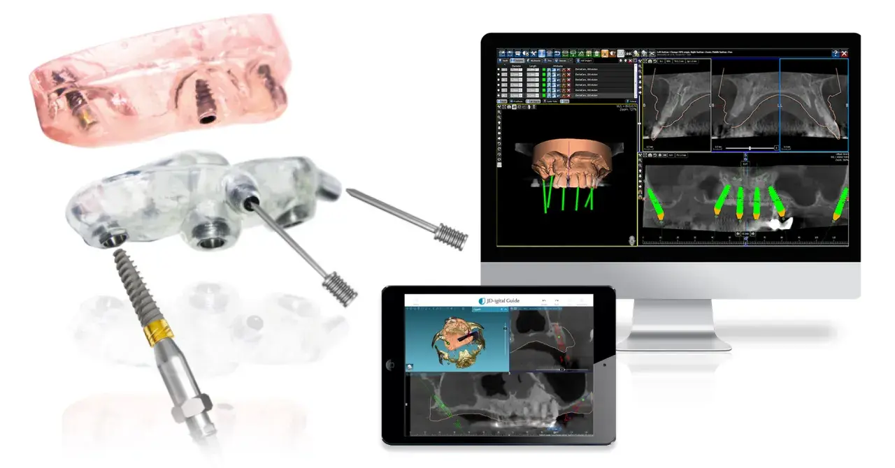 Componenti per chirurgia guidata dentale: guide, impianti e software di pianificazione 3D.