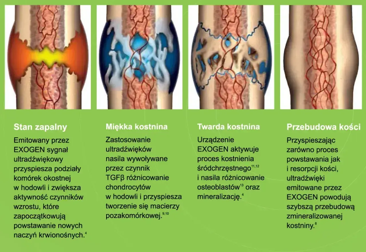 Ilustracja pokazuje etapy zrostu kości: stan zapalny, miękką i twardą kostninę, a na końcu przebudowę kości.