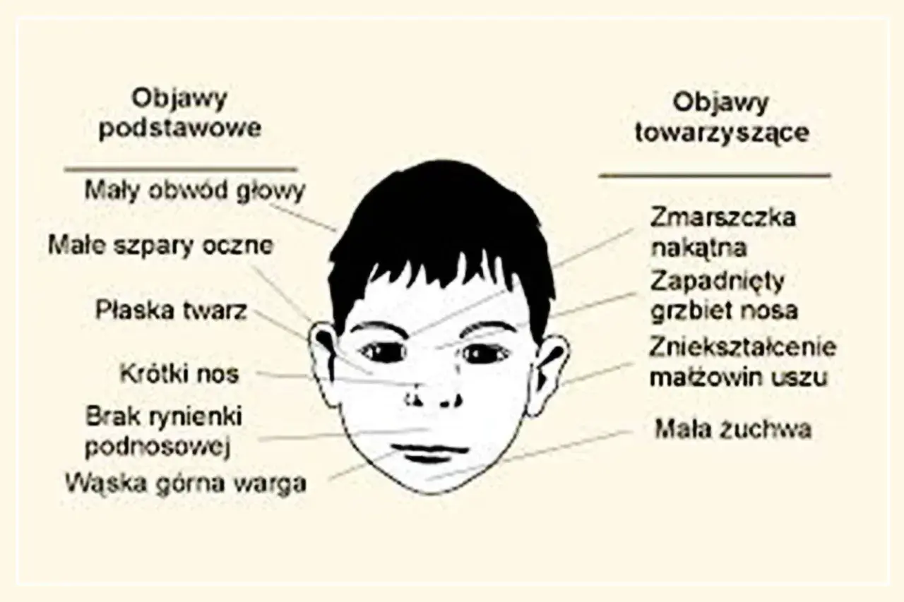 Ilustracja twarzy dziecka z zaznaczonymi cechami, jak mały obwód głowy, płaska twarz, krótki nos, wąska warga, zmarszczka nakątna, zapadnięty grzbiet nosa, zniekształcenie małżowin uszu, mała żuchwa. To mogą być objawy z zespołu FAS.