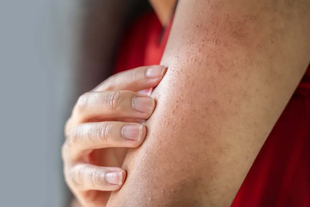 En hand undersöker en arm med en knottrig panna, troligen ett utslag eller torr hud.