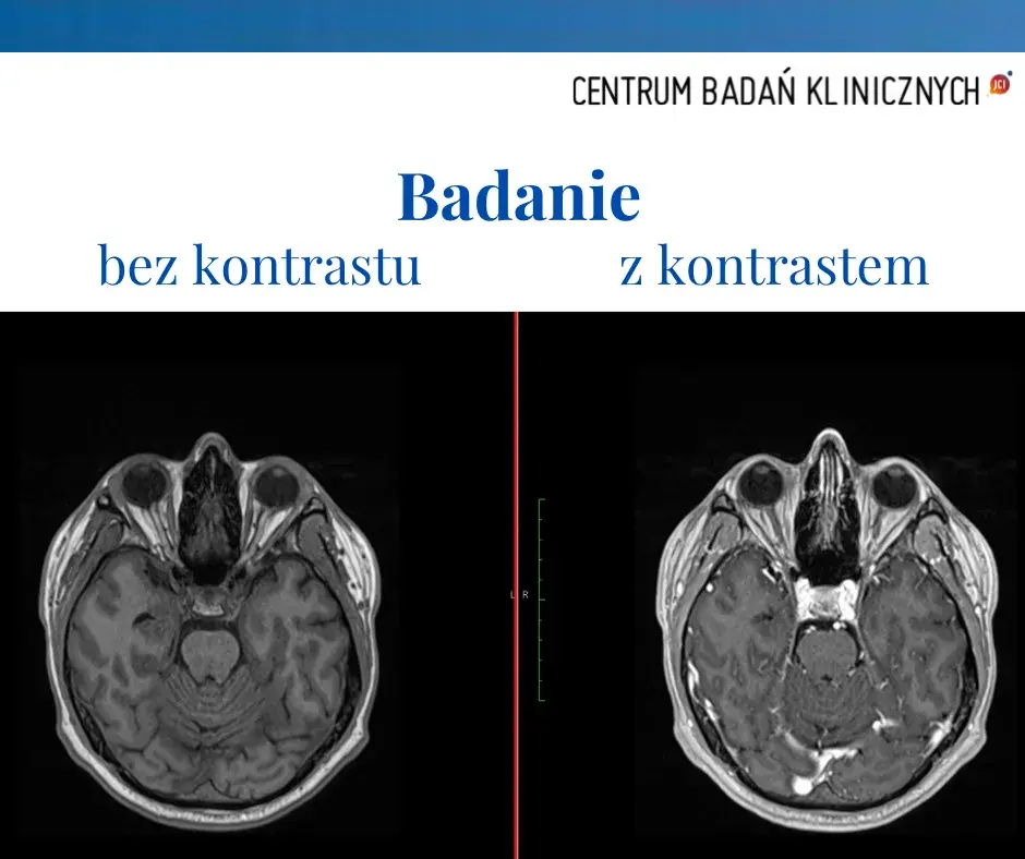 Alkohol po kontraście: czy można pić i jakie są zagrożenia?