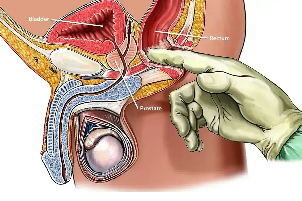 Ilustracja anatomiczna pokazująca badanie per rectum. Dłoń w rękawiczce dotyka prostaty przez odbytnicę.