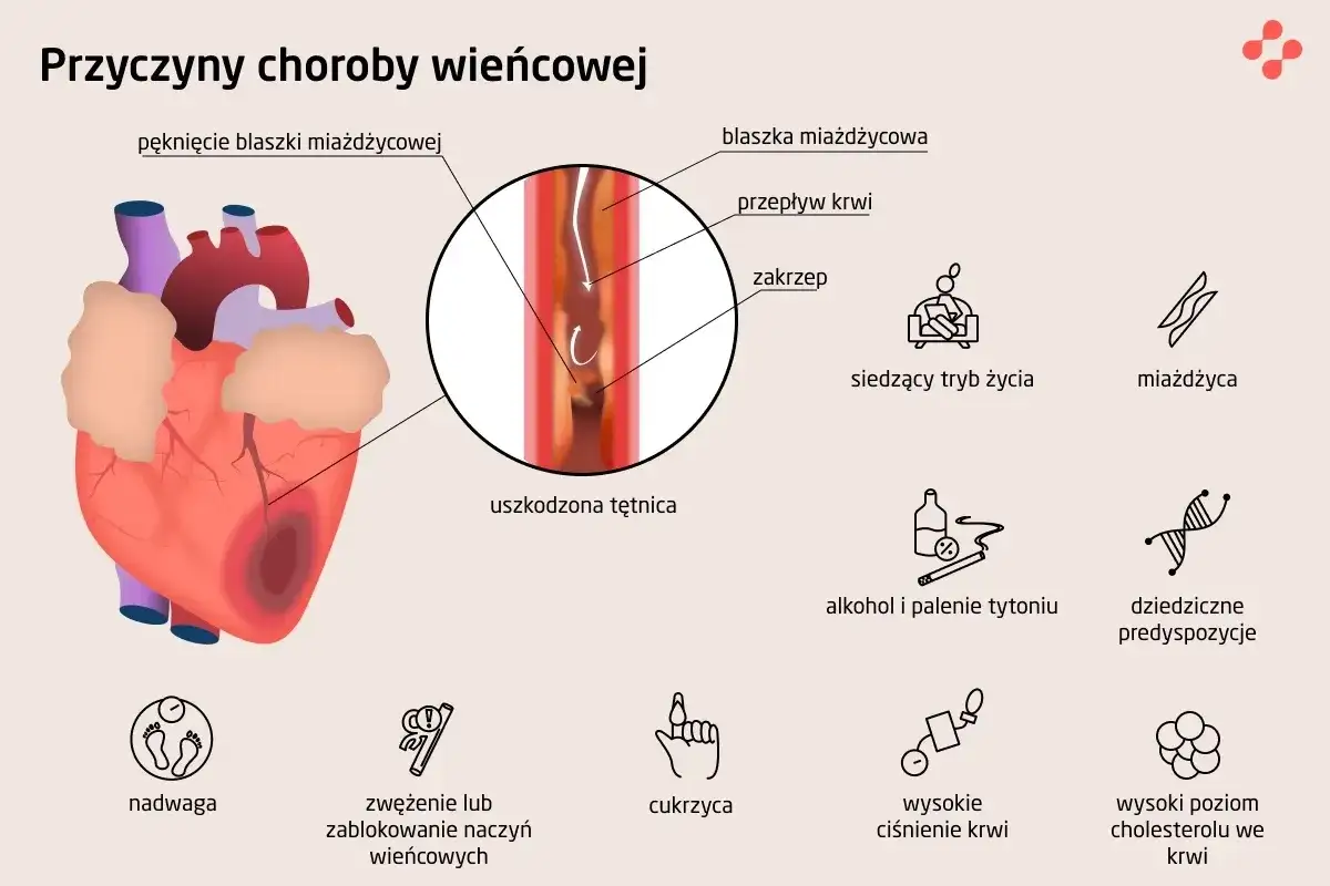 Ilustracja przedstawia serce i czynniki ryzyka choroby wieńcowej: miażdżycę, nadwagę, cukrzycę, wysokie ciśnienie, alkohol, palenie, siedzący tryb życia i predyspozycje genetyczne.