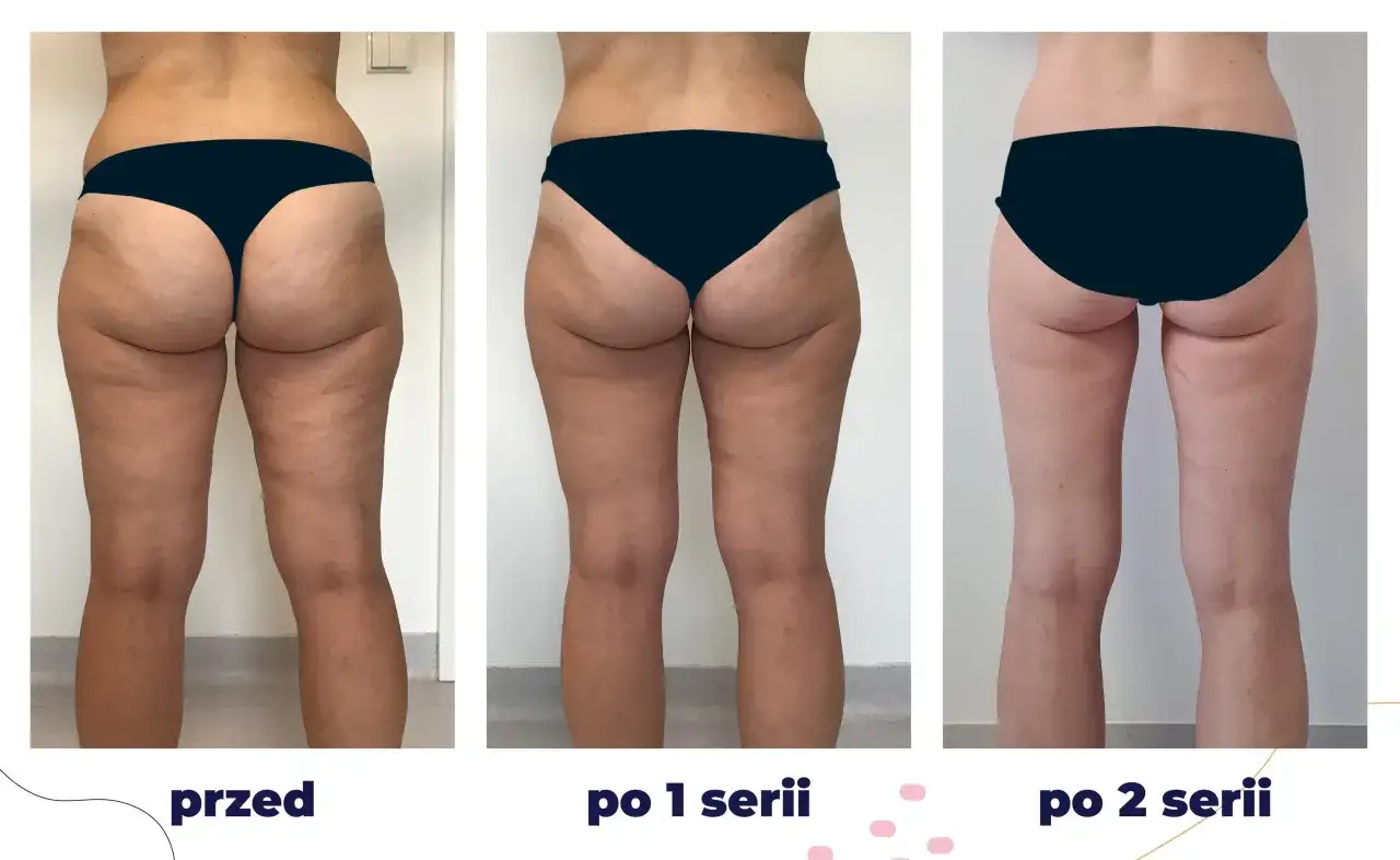 Przed i po kriolipolizie ud. Widoczne zmniejszenie cellulitu i poprawa jędrności skóry po 1 i 2 seriach zabiegu.