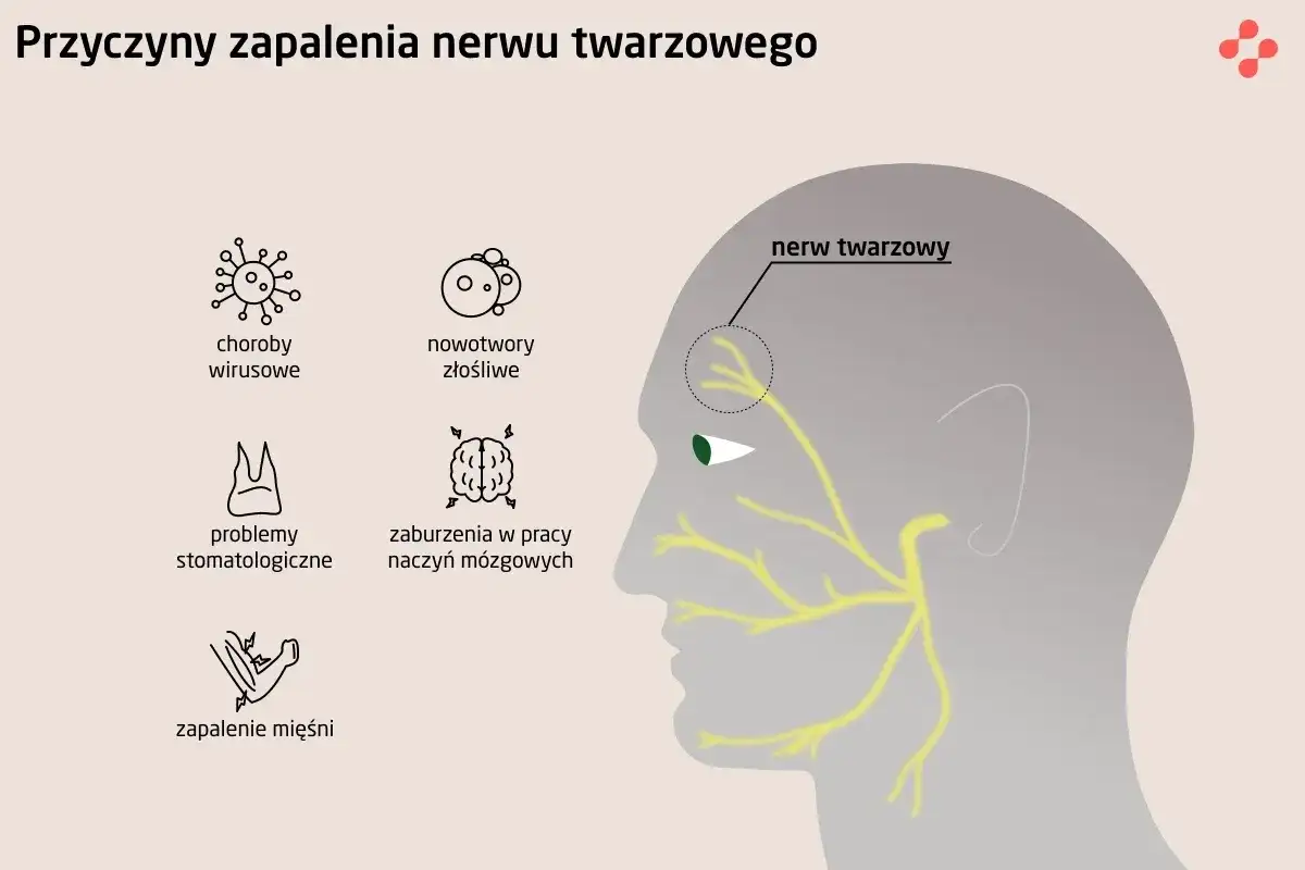 Ilustracja przedstawia przyczyny zapalenia nerwu twarzowego: wirusy, nowotwory, problemy stomatologiczne, zaburzenia naczyń mózgowych i zapalenie mięśni.