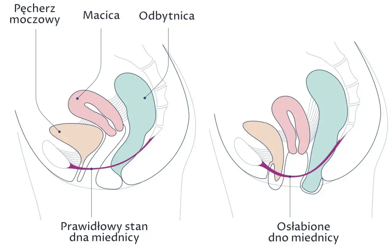 Porównanie prawidłowego i osłabionego dna miednicy. Na drugim obrazku widać obniżenie narządów, co może prowadzić do wypadania pochwy.