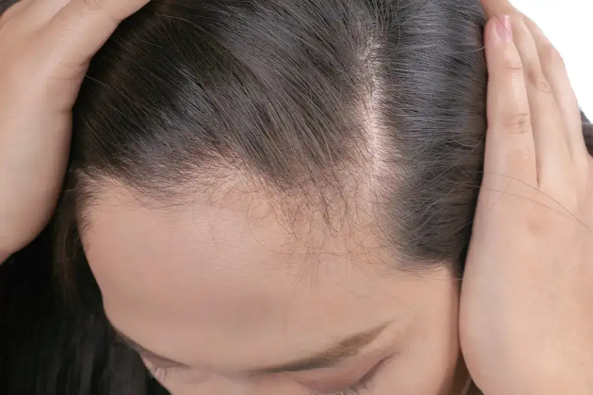 Widoczne przerzedzenie włosów na skroniach i czole. Czy to alopecia? Zastanawiasz się, alopecia co to jest i jak sobie z tym radzić?
