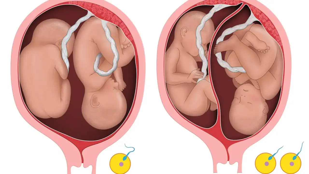 Dwa płody w macicy, ilustracja pokazująca niezauważona ciąża mnoga. Dwa zarodki z plemnikami poniżej.