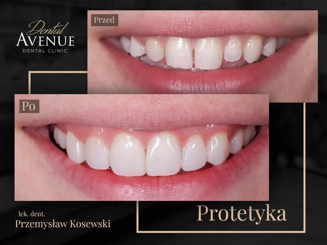 Przed i po: metamorfoza uśmiechu dzięki licówkom kompozytowym a porcelanowym. Piękne, białe zęby po zabiegu.