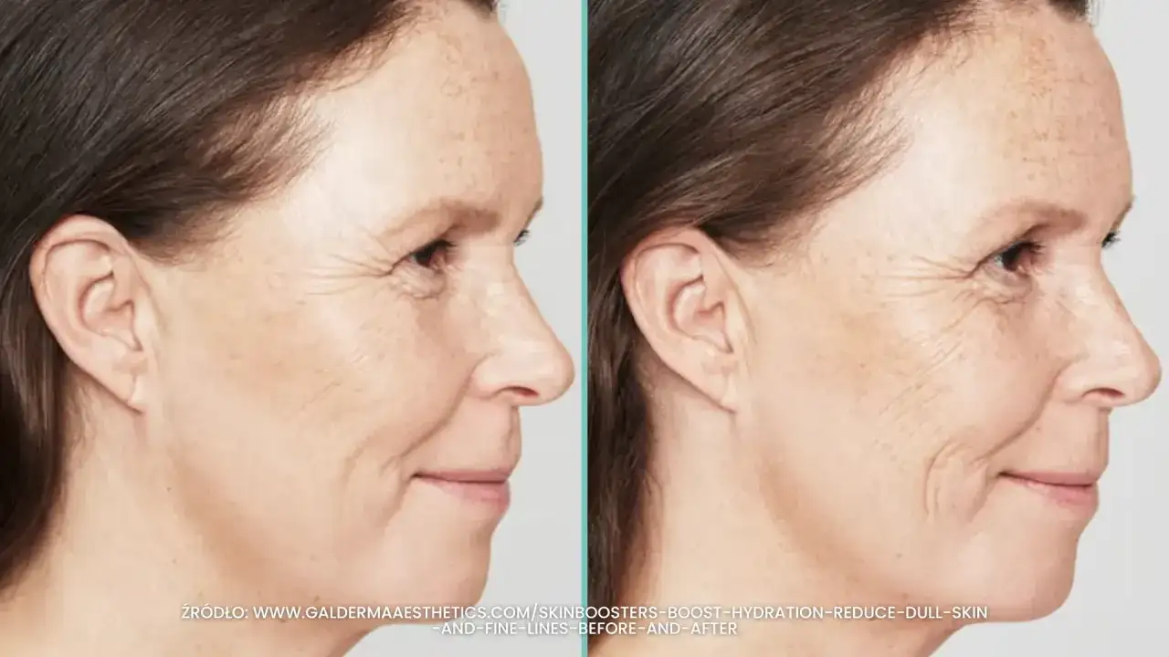 Porównanie skóry przed i po zabiegu skinbooster. Widać wygładzenie drobnych zmarszczek i poprawę nawilżenia.
