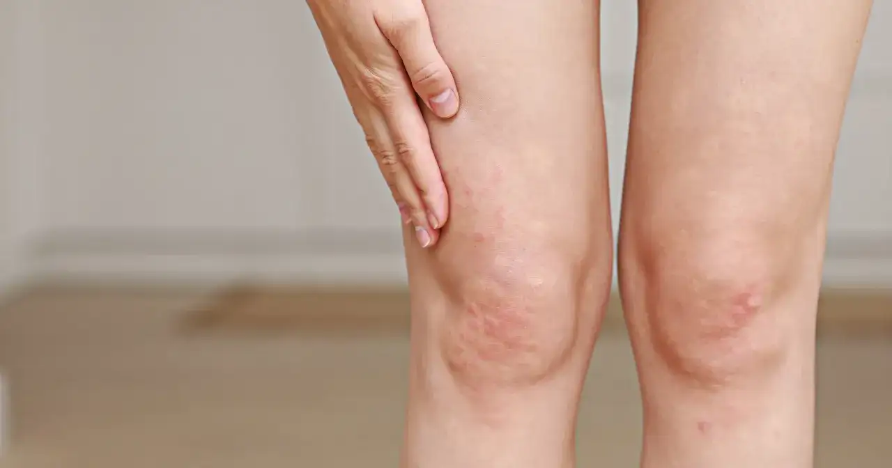 Dłonie dotykają kolana z zaczerwienieniem i wysypką, które mogą być objawami wysokiego cholesterolu.