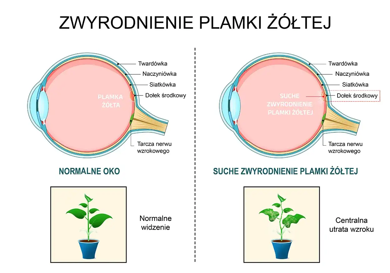 Porównanie zdrowego oka z suchym zwyrodnieniem plamki żółtej, pokazujące utratę ostrości widzenia.