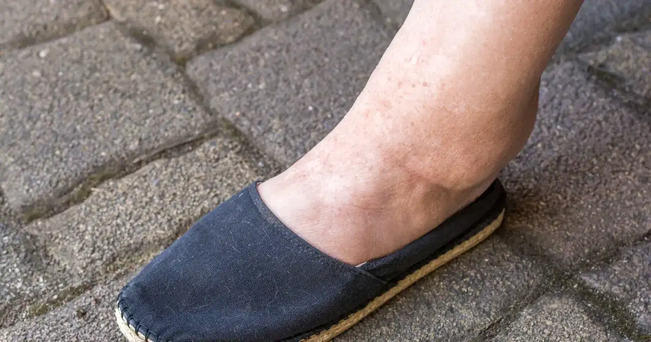Obrzęk kostki, jeden z objawów marskości nerki, widoczny na nodze w czarnym bucie na tle kostki brukowej.