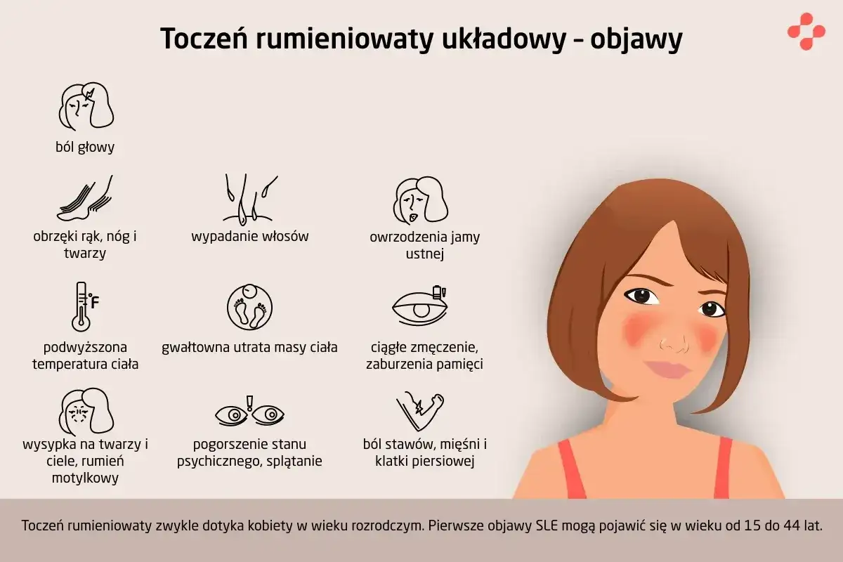 Grafika przedstawia objawy tocznia rumieniowatego układowego (SLE): ból głowy, obrzęki, wypadanie włosów, owrzodzenia jamy ustnej, gorączkę, utratę wagi, zmęczenie, wysypkę motylkową, problemy psychiczne i bóle stawów.