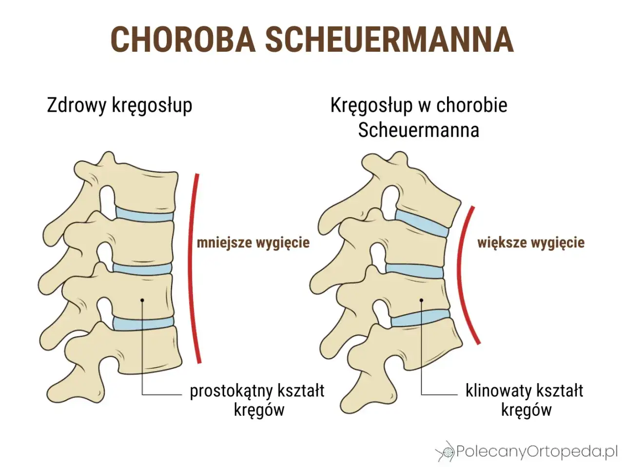 Ilustracja porównująca zdrowy kręgosłup z kręgosłupem w chorobie Scheuermanna.
