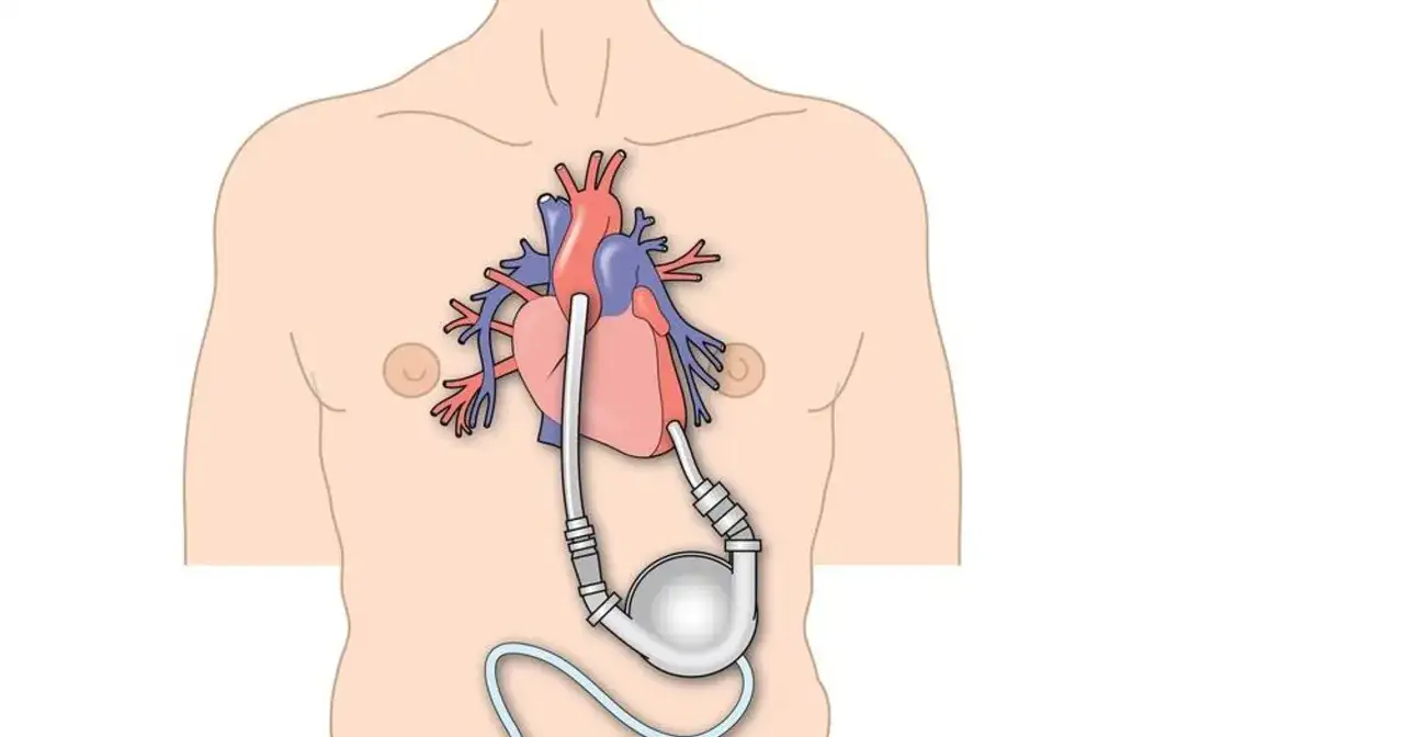 Schemat przedstawia serce z wszczepioną pompą wspomagającą krążenie, ilustrując cykl hemodynamiczny serca.