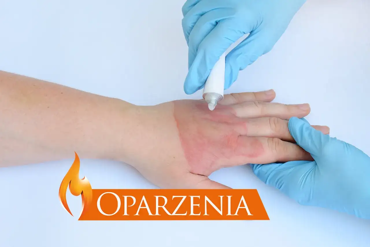 Ręka z oparzeniem, na którą nakładany jest preparat. Dowiedz się, jak zrobić opatrunek na oparzenia.