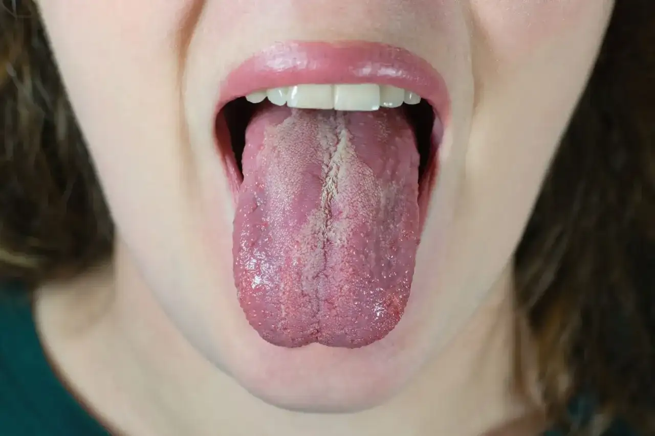 Język z białym nalotem, objaw kandydozy jamy ustnej. Widoczne grudki i zaczerwienienie.