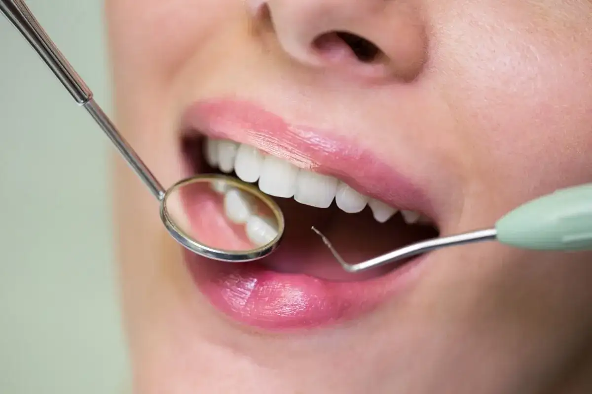 Usta kobiety z białymi zębami, badane lusterkiem dentystycznym. Na dziąśle widoczna jest mała, biała kulka.