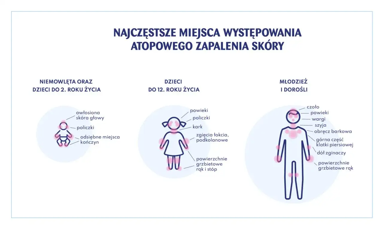 Ilustracja pokazuje miejsca występowania azs u dzieci w różnym wieku: niemowląt, dzieci do 12 lat i młodzieży/dorosłych.