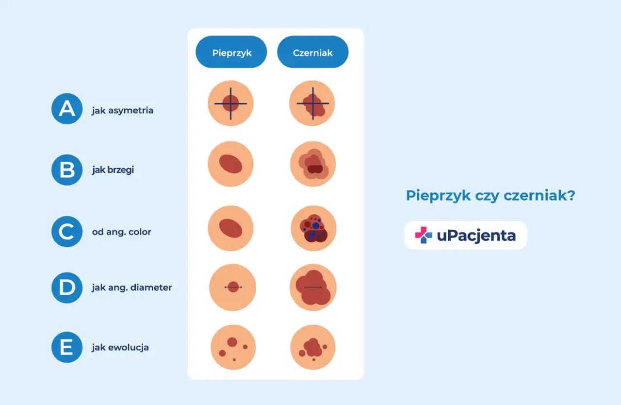 Ilustracja porównująca pieprzyk i czerniaka według kryteriów ABCDE.