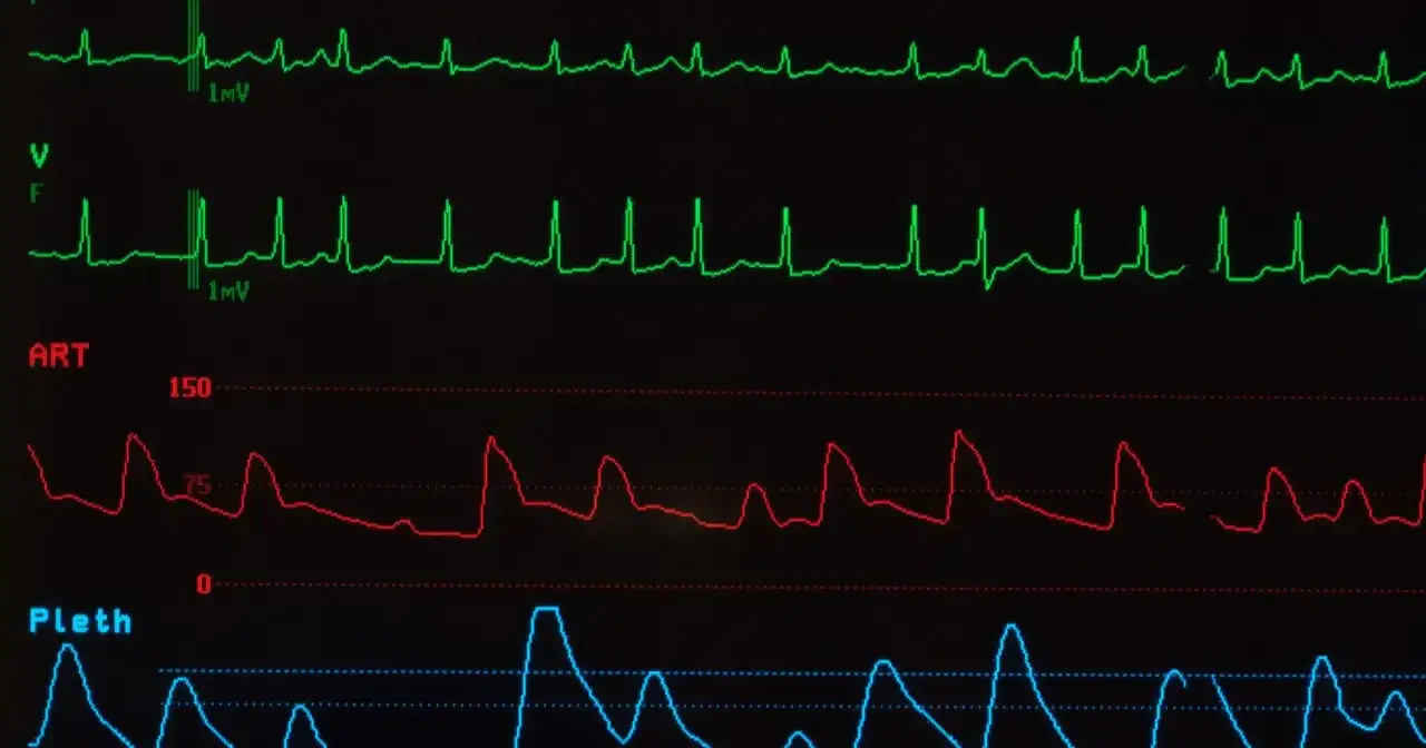 Monitor EKG pokazuje nieregularne fale, co może sugerować migotanie przedsionków. Długość życia z migotaniem przedsionków zależy od wielu czynników.