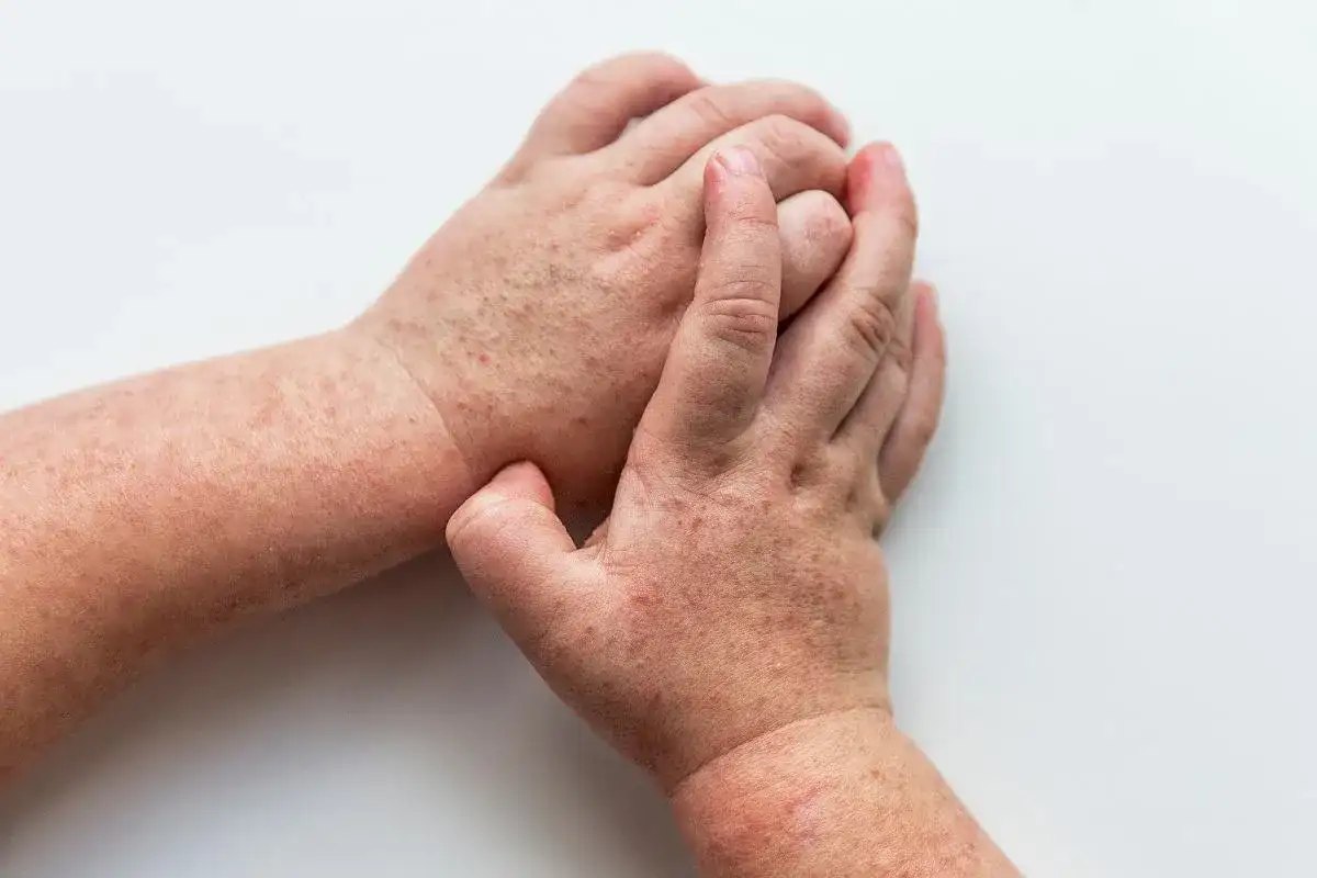Dłonie z wysypką, która może być jednym z objawów HIV. Czerwone plamki na skórze.