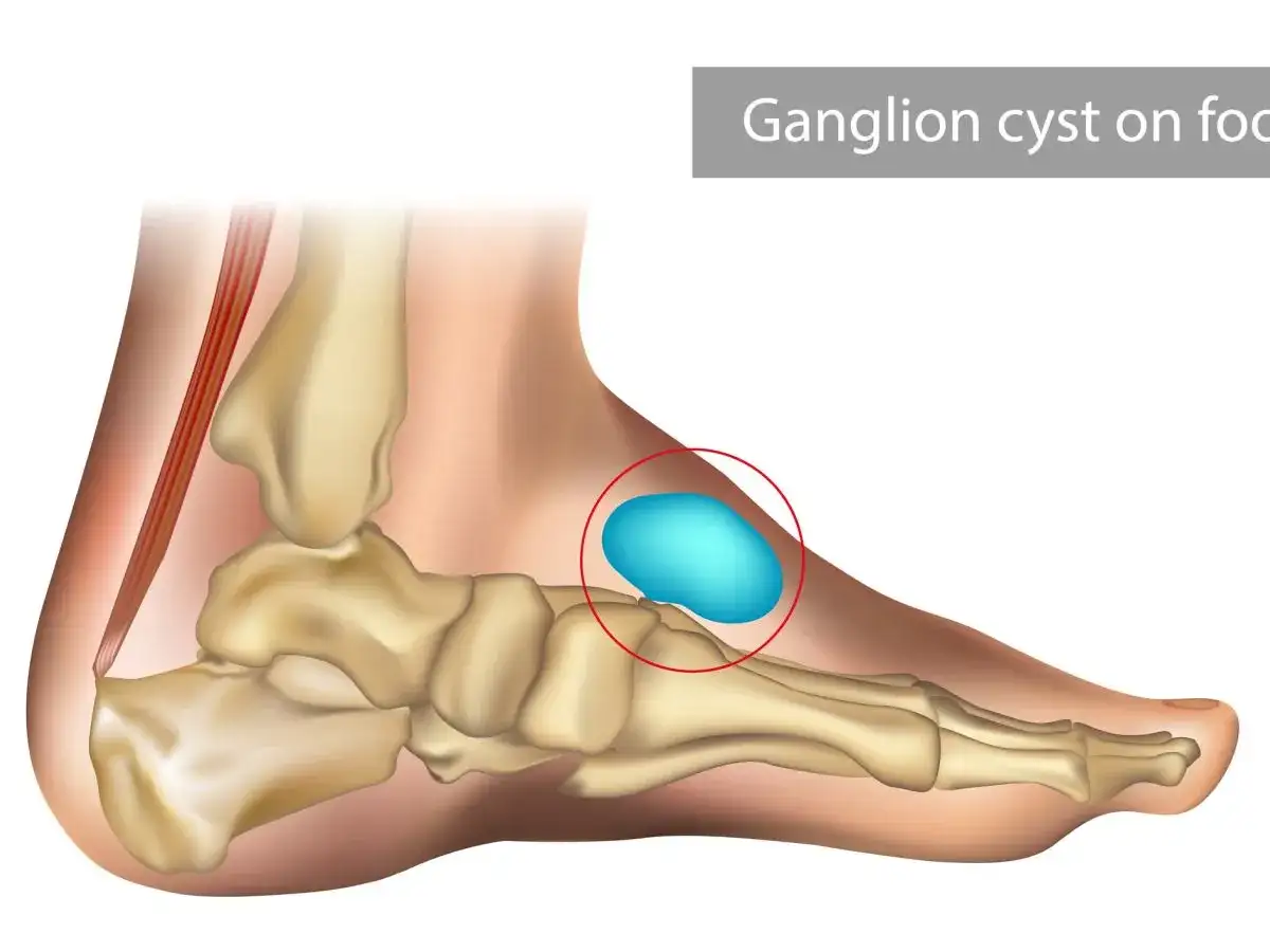 Anatomia stopy z widocznym ganglion na stopie, zaznaczonym czerwonym okręgiem.